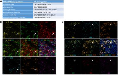 Spatiotemporal Analysis of B Cell- and Antibody Secreting Cell-Subsets in Human Melanoma Reveals Metastasis-, Tumor Stage-, and Age-Associated Dynamics